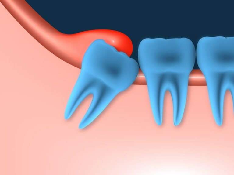 Extraction des dents de sagesse à Casablanca