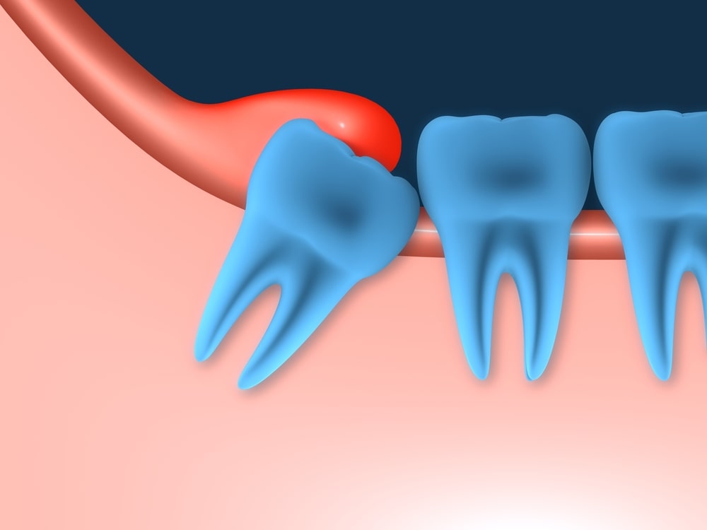 Extraction des dents de sagesse à Casablanca