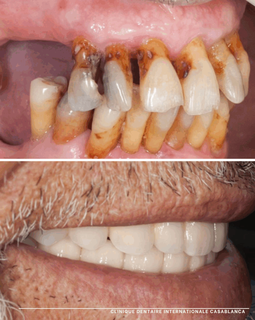 Implant dentaire Clinique dentaire internationale casablanca