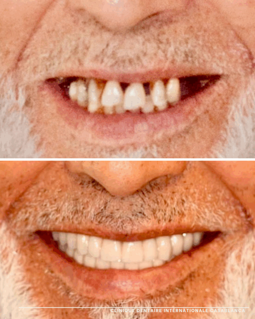 Implant dentaire Clinique dentaire internationale casablanca