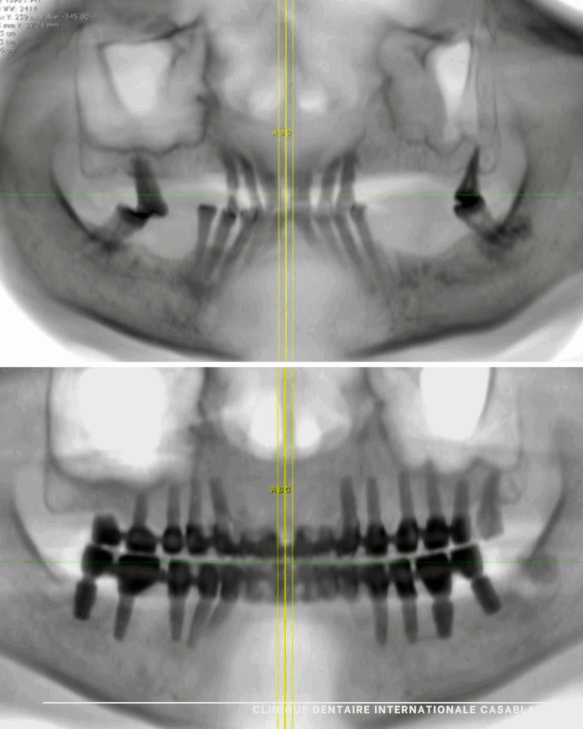 Implant dentaire Clinique dentaire internationale casablanca