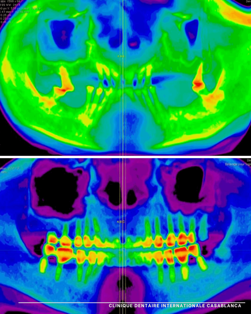 Implant dentaire Clinique dentaire internationale casablanca