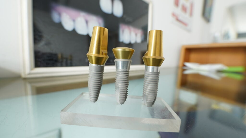 Implants dentaires et piliers, Clinique Dentaire Internationale Casablanca