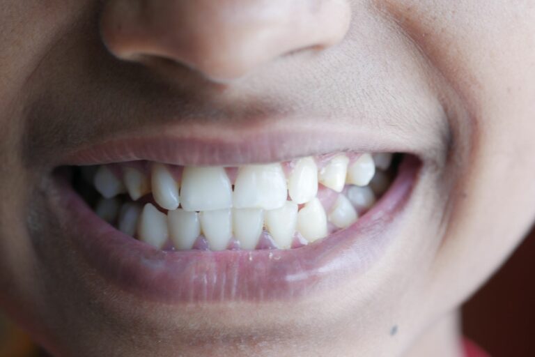 Sourire naturel après facettes dentaires